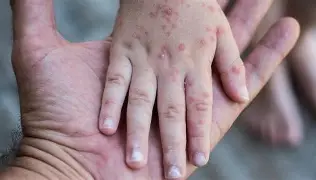 Brote de Coxsackie afecta escuelas en Tlaxcala